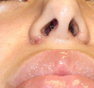 Reduction of the nostrils