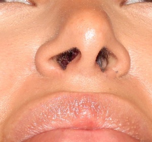 Reduction of the nostrils