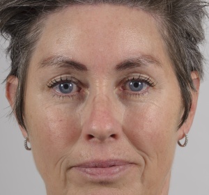 After the lift there is no more need for an eyelid correction. The scar of the forehead lift is placed at the hairline