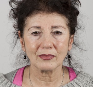 A natural result after a foreheadlift without eyelid surgery