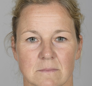 After the lift the forehead becomes shorter, has less wrinkles and is more relaxed