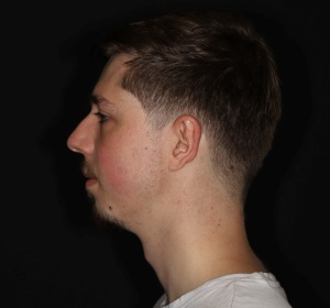 A stronger jawline after a chin implant