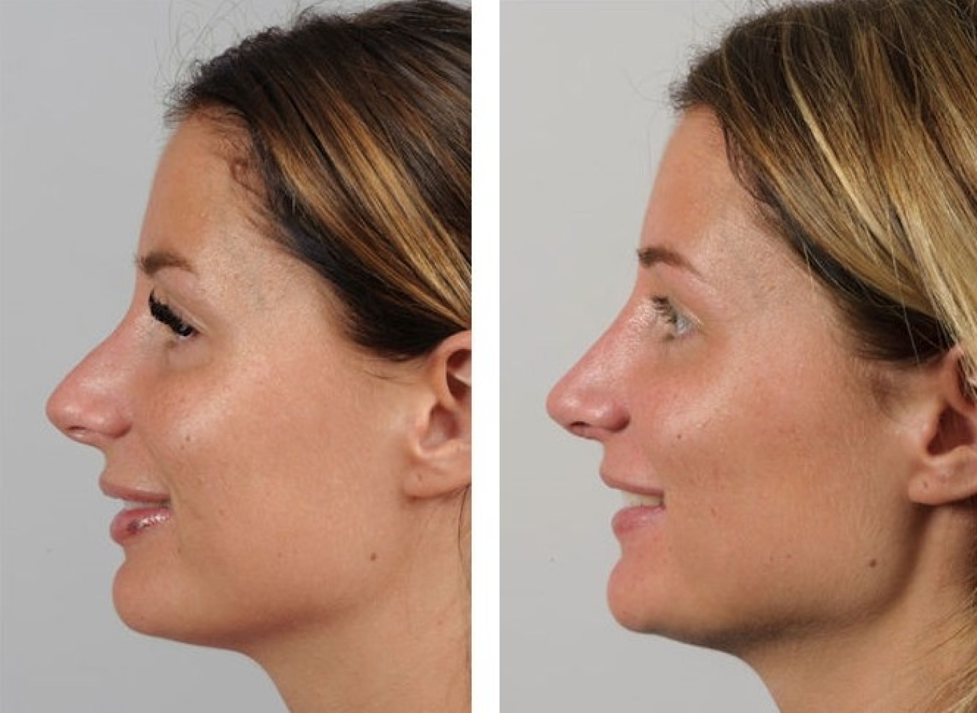 Rhinoplasty before and after photos