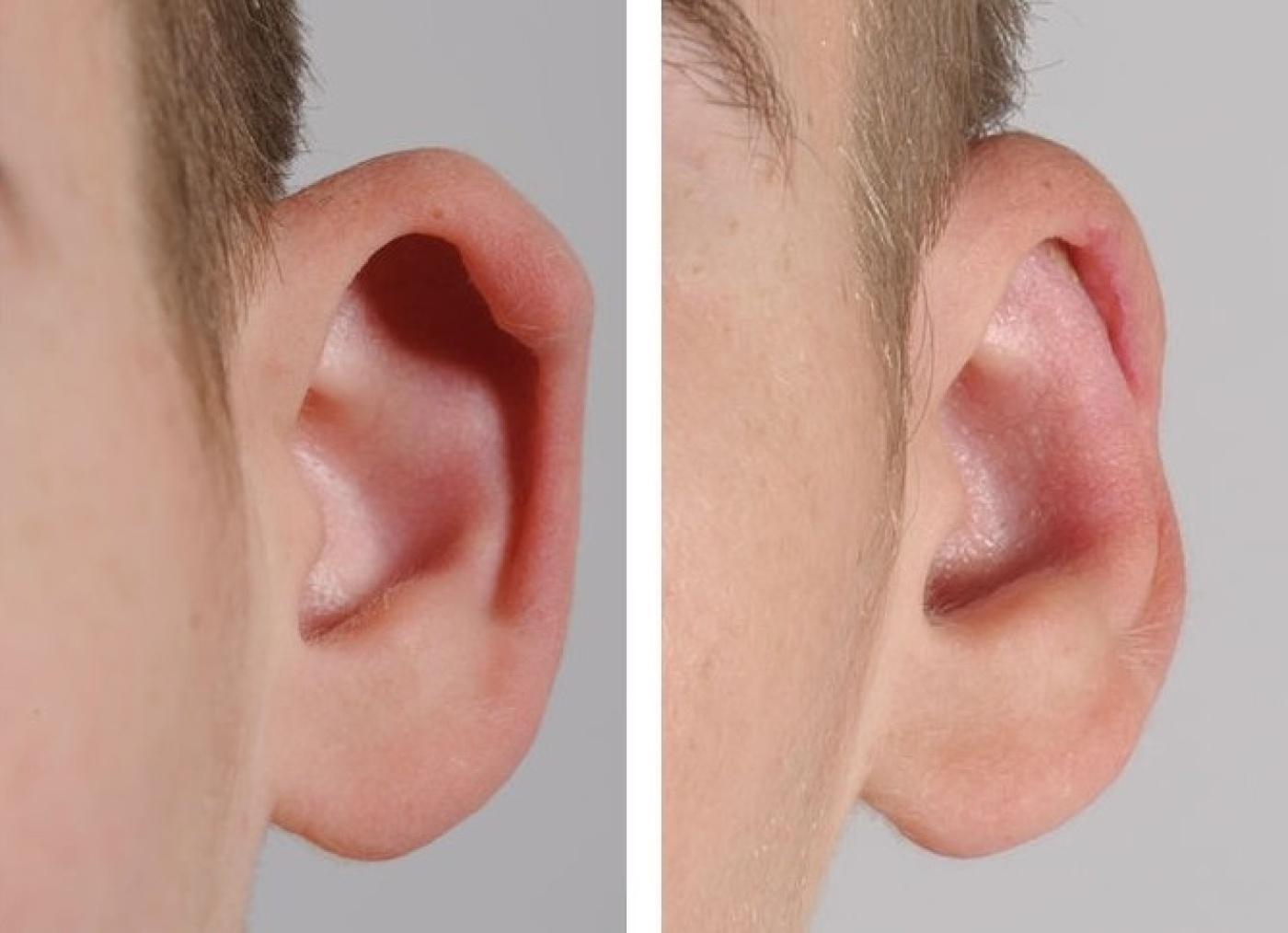 Before and after the ear correction treatment