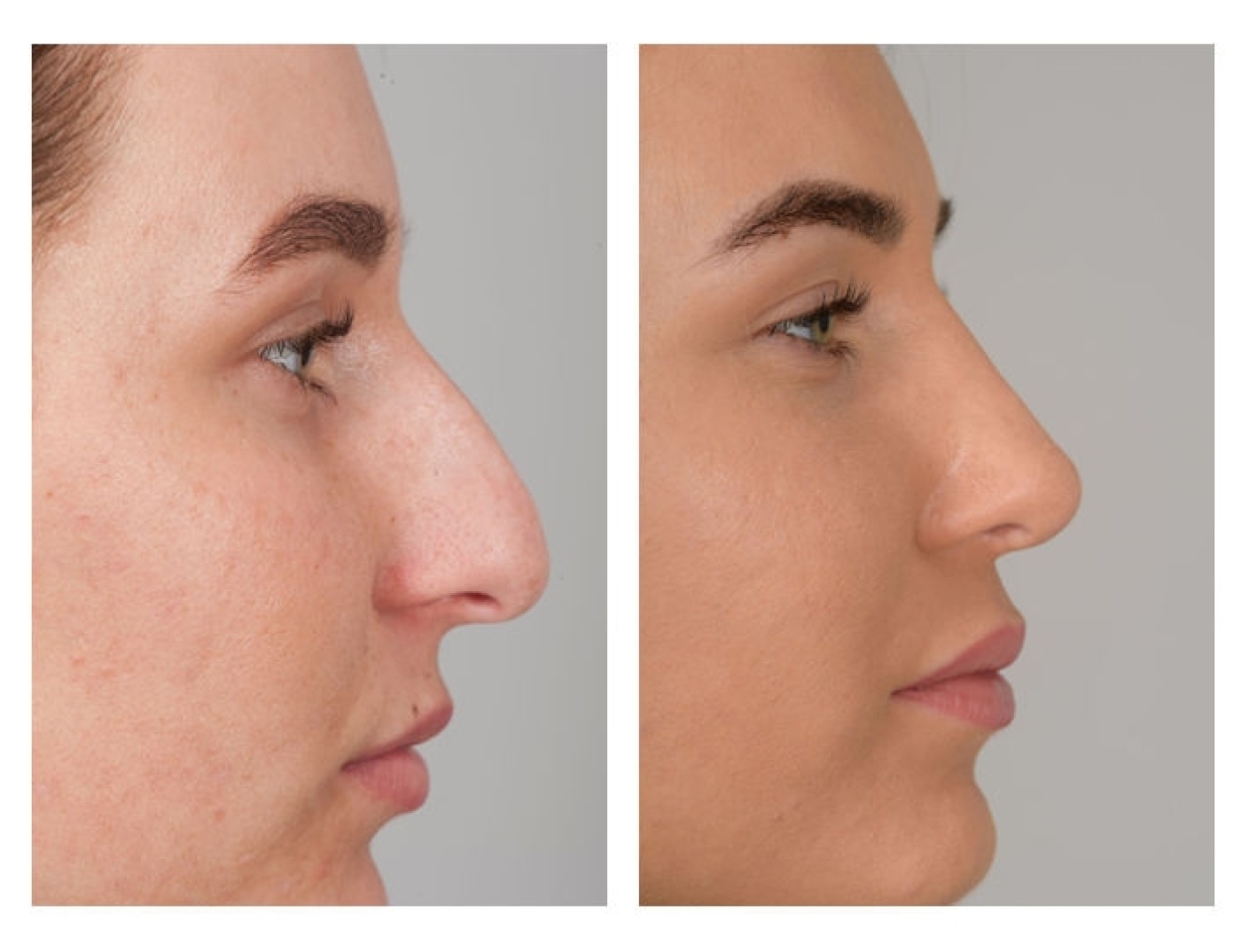 Nose correction