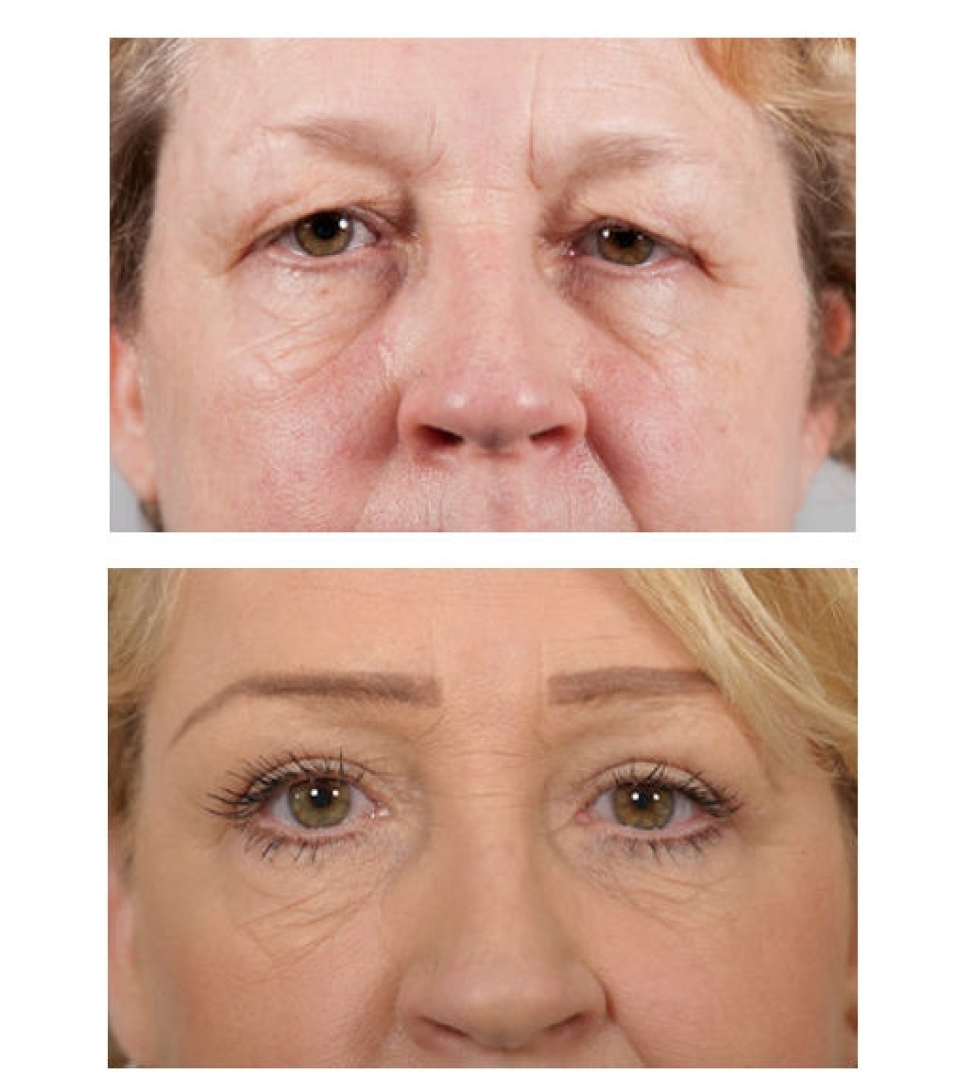 Eyelid correction, female