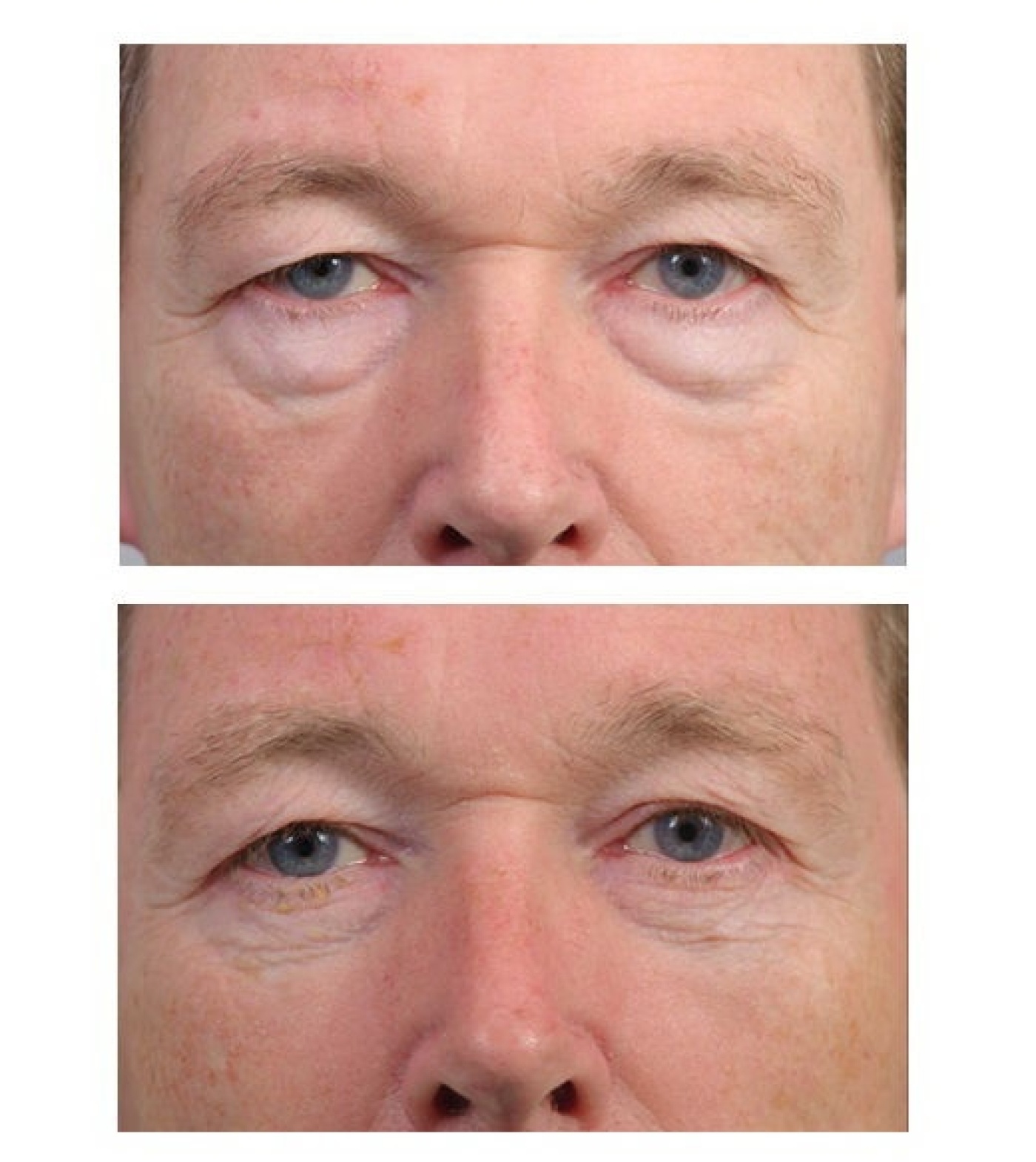 Eyelid correction, male