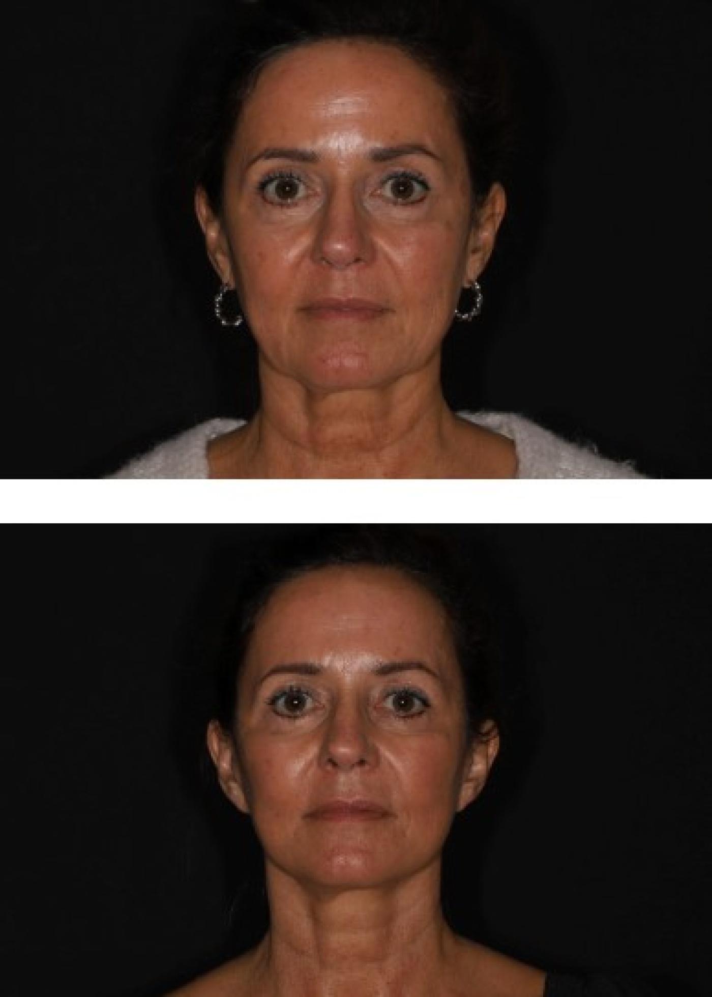 Voor- en na foto van een facelift