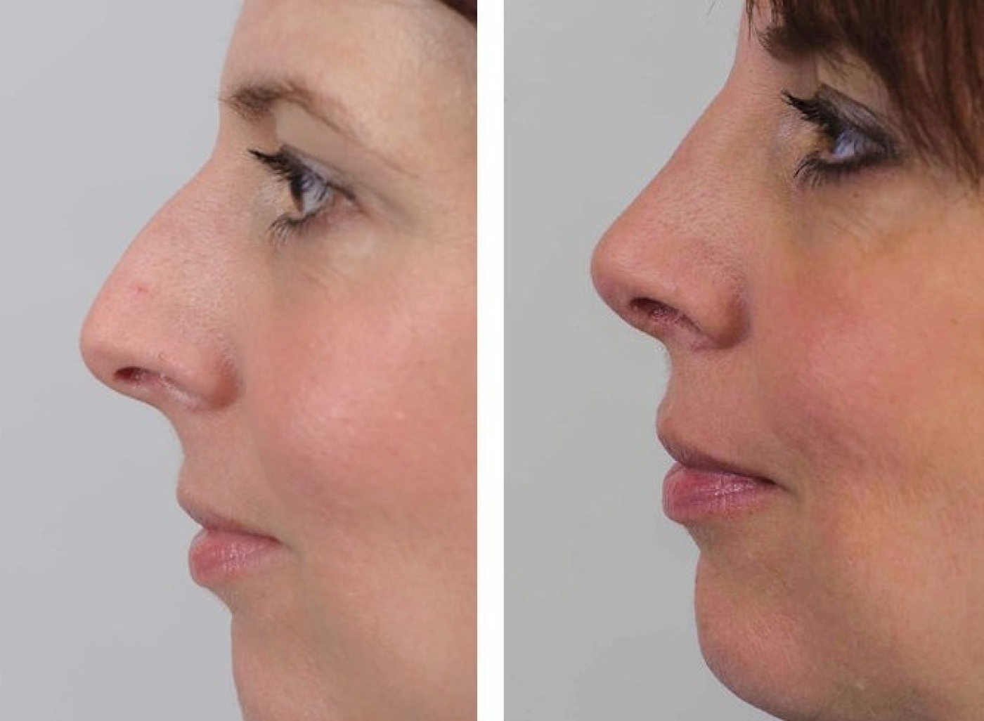 Rhinoplasty before and after photos (2)