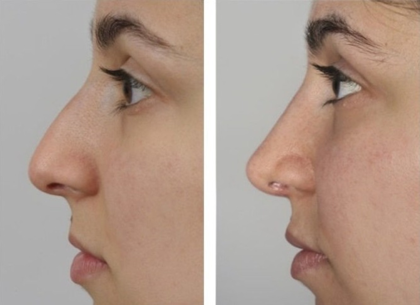 For many patients the ideal nose correction: the tip has just a little more projection than the nose.