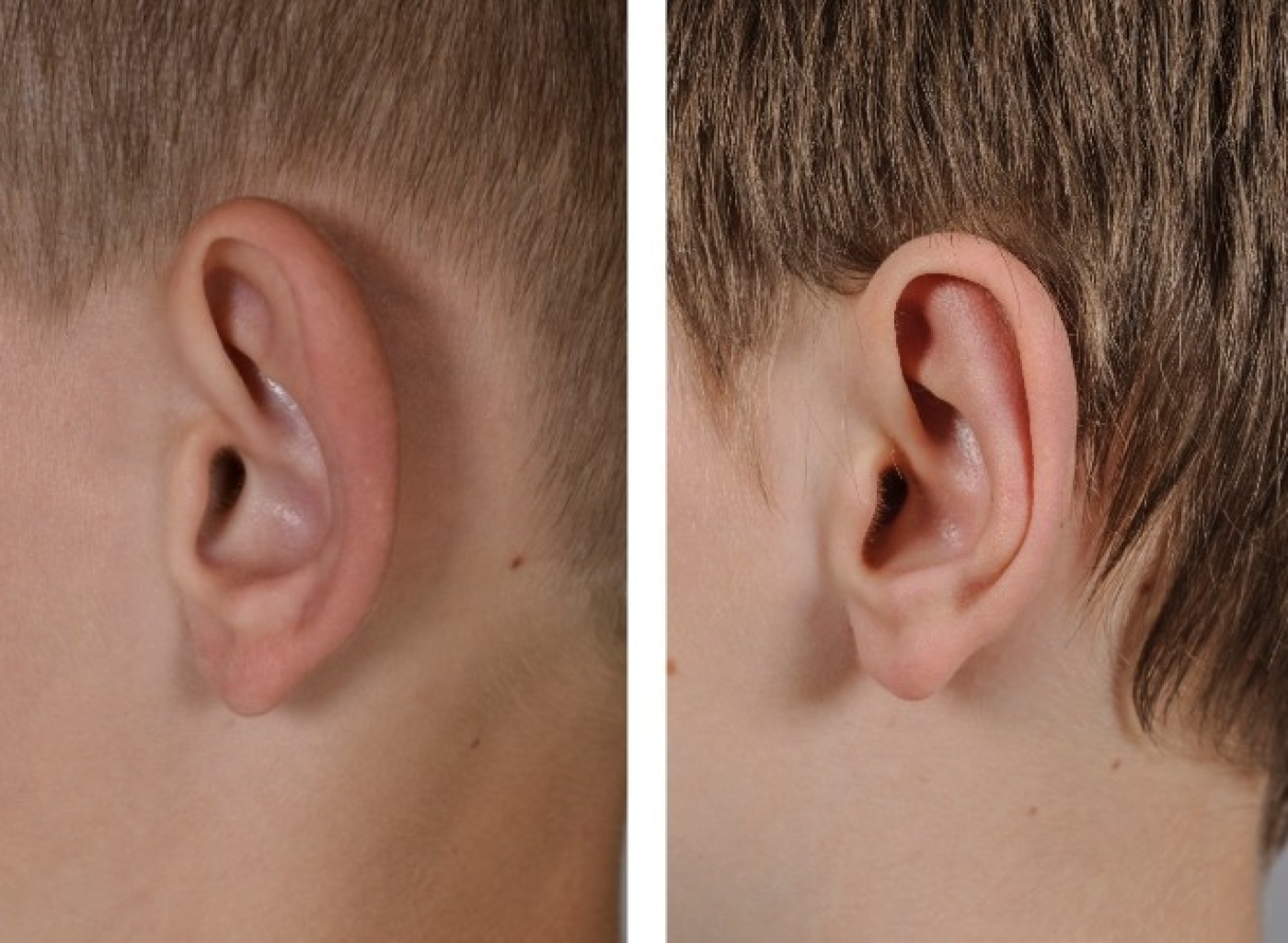 Before and after the ear correction treatment