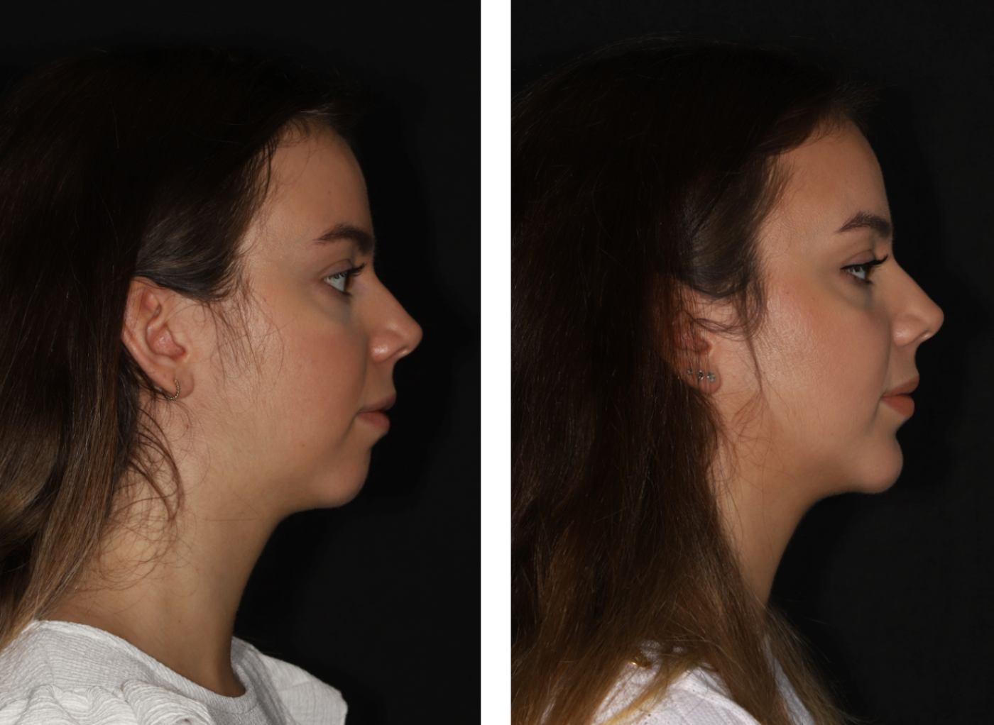 Chin correction