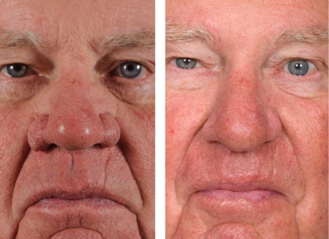 Rhinophyma of aardbeineus correctie